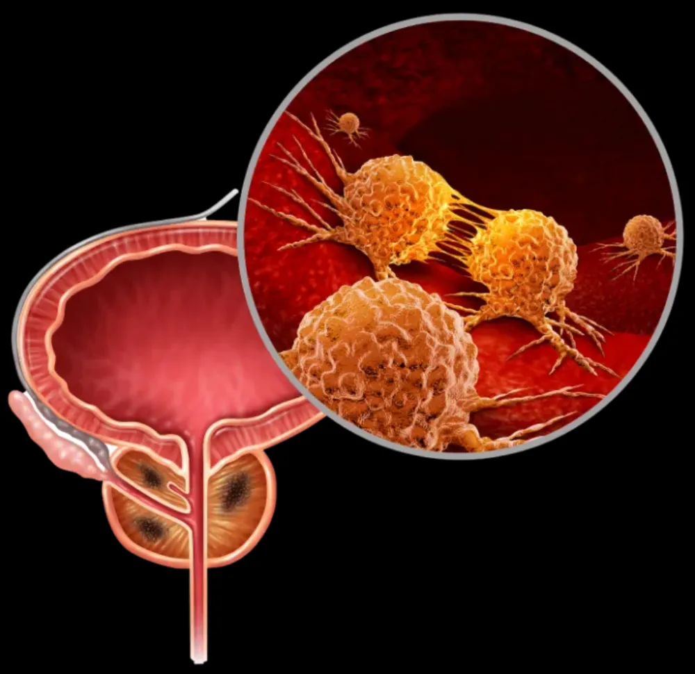 Ilustracion del cancer de prostata