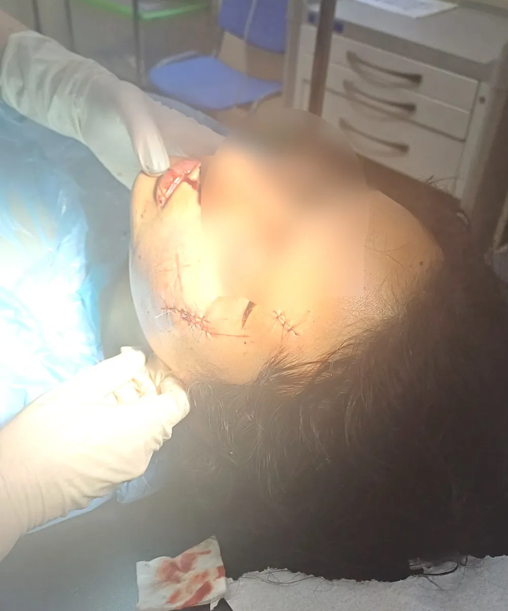 Menor de edad con cortes en la cara en Puren