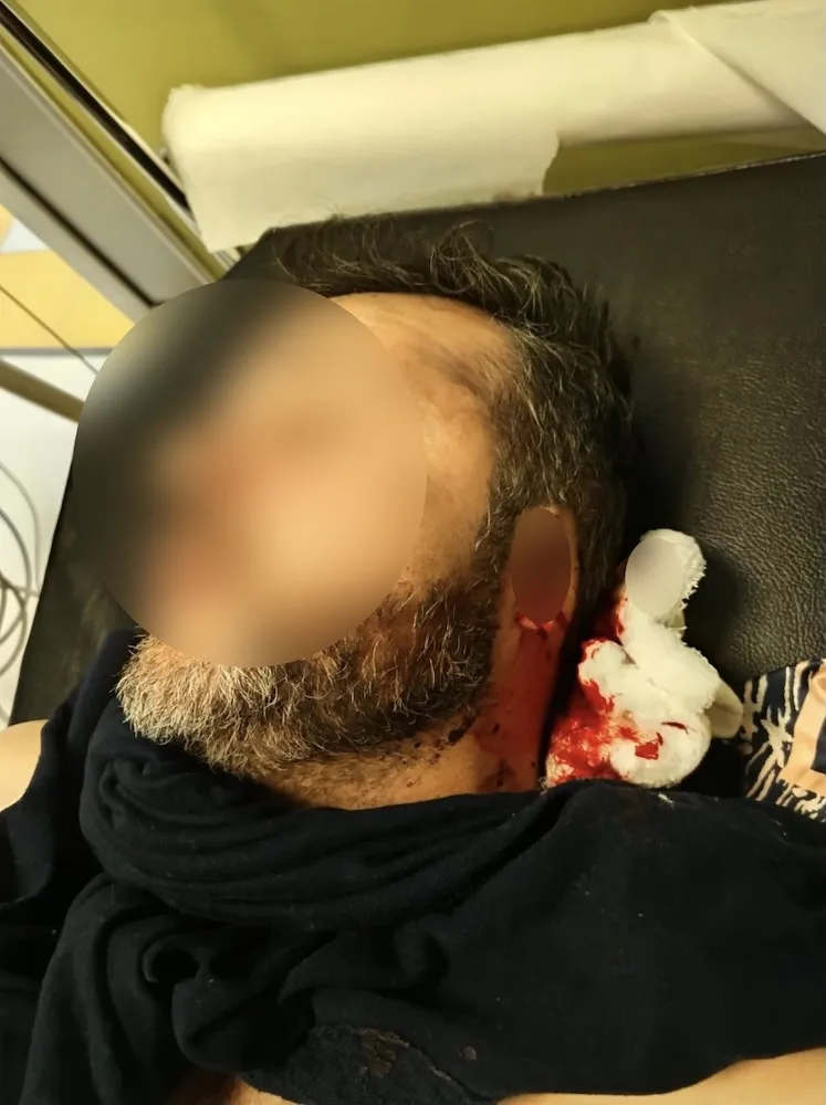 Persona con perdida del pabellon auricular externo por mordida